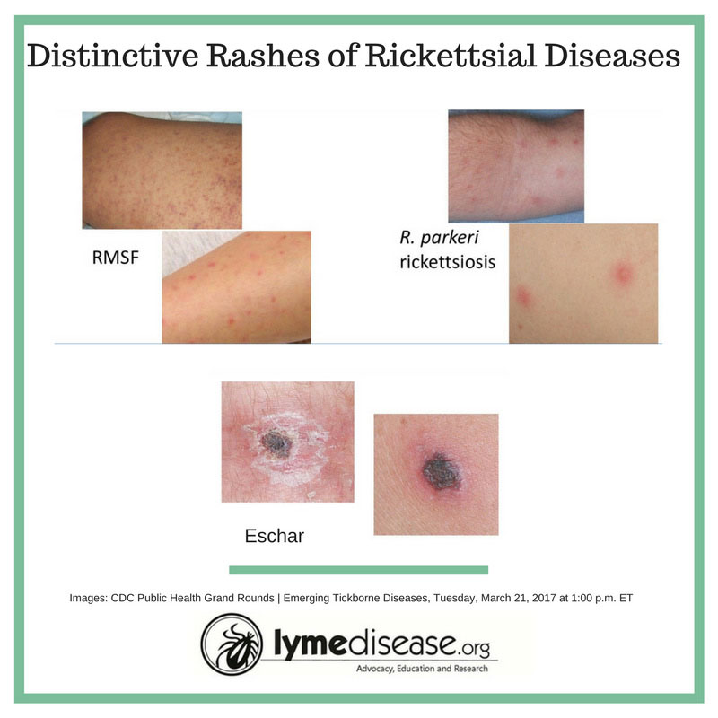 Rickettsiose , une co-infection méconnue. La rickettiose en France ...