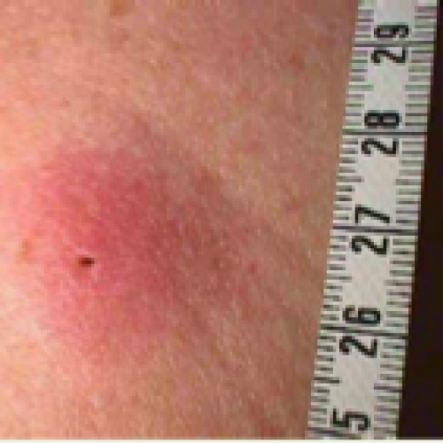 Santé Vivante – dossier Borrélioses de Lyme